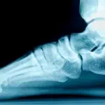 Comment Reconnaitre et corriger un Pied plat ?