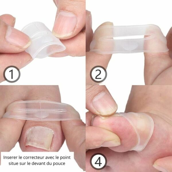 Correcteur Pousse-ongle Sandyconfort Correcteur Pousse-ongle Sandyconfort